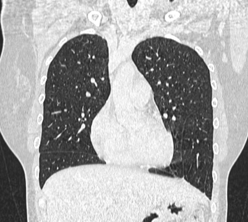 Bronchial atresia (Radiopaedia 50007-55297 Coronal lung window 33).jpg