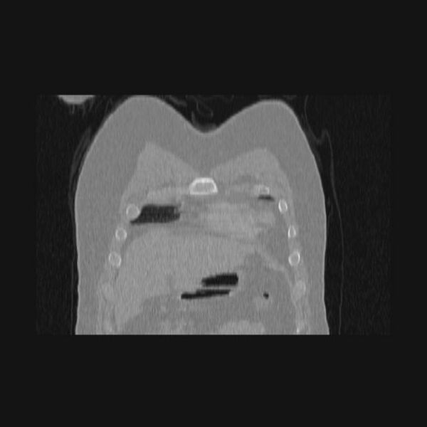 File:Bronchial atresia (Radiopaedia 60685-68439 Coronal lung window 69).jpg