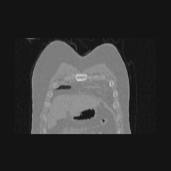 File:Bronchial atresia (Radiopaedia 60685-68439 Coronal lung window 71).jpg