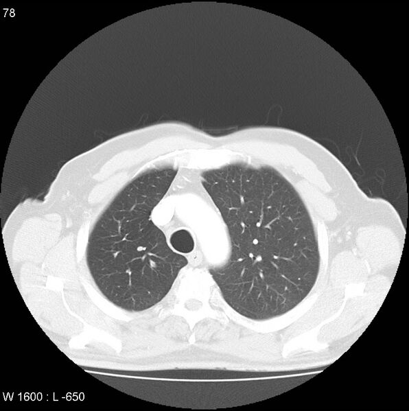 File:Bronchial carcinoid tumor with right lower lobe collapse (Radiopaedia 29060-29422 B 16).jpg
