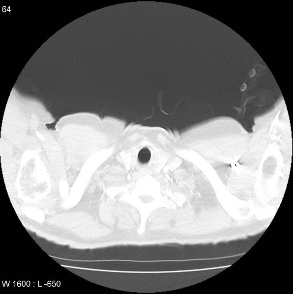 File:Bronchial carcinoid tumor with right lower lobe collapse (Radiopaedia 29060-29422 B 2).jpg