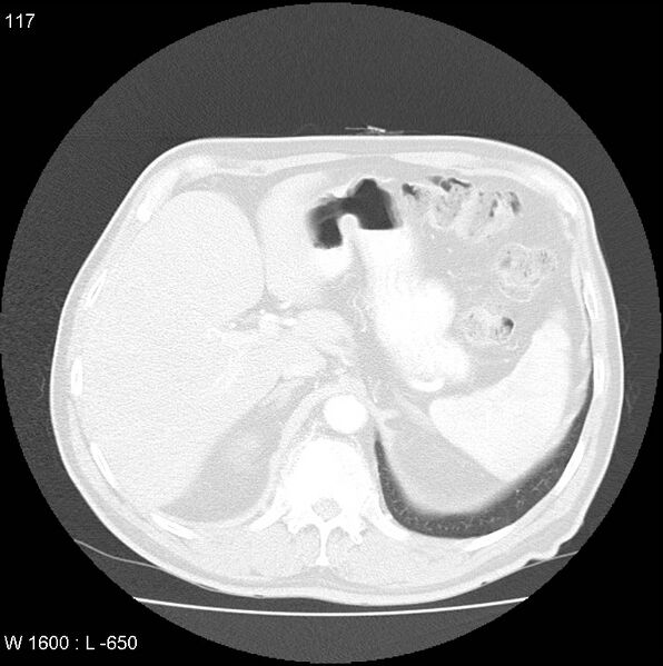 File:Bronchial carcinoid tumor with right lower lobe collapse (Radiopaedia 29060-29422 B 55).jpg
