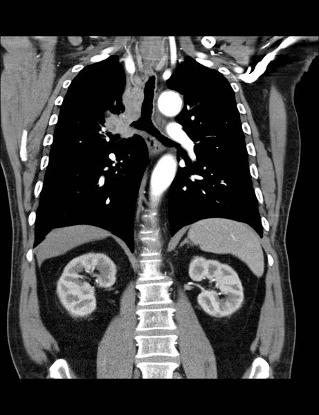 File:Bronchial carcinoma (Radiopaedia 18285-18112 A 6).jpg