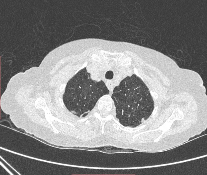 Bronchiectasis (Radiopaedia 72693-83293 Axial lung window 14).jpg