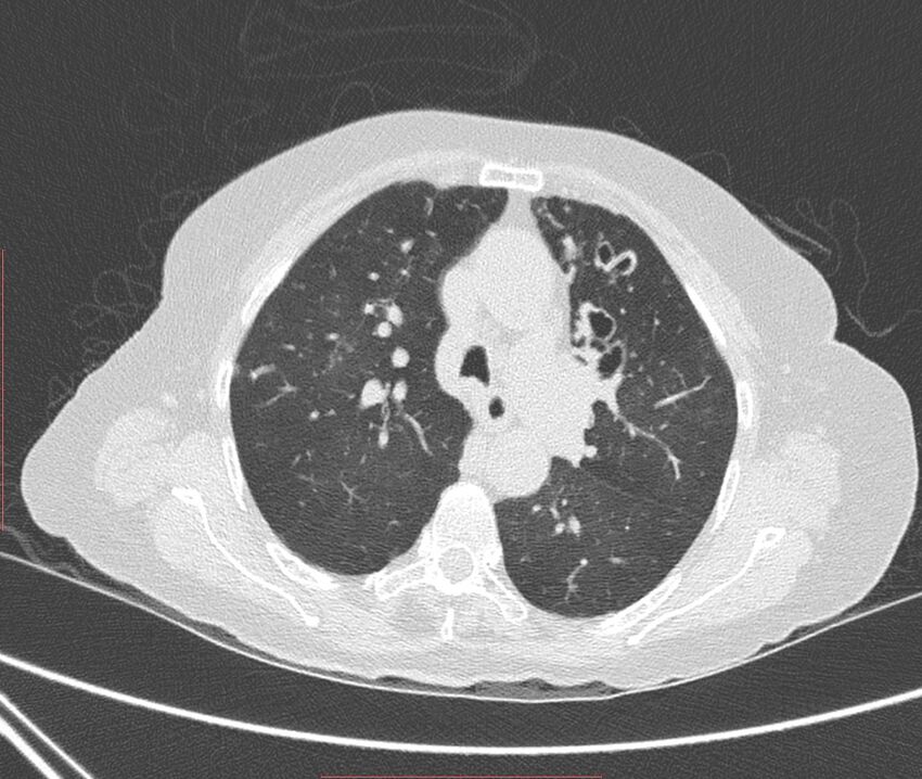 Bronchiectasis (Radiopaedia 72693-83293 Axial lung window 45).jpg