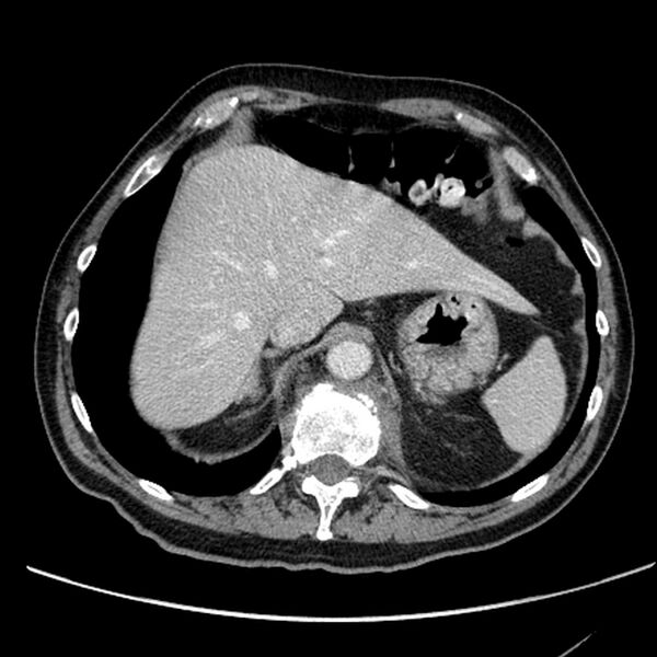 File:Bronchogenic carcinoma with L1 vertebra metastasis (Radiopaedia 9096-9805 Axial C+ delayed 31).jpg
