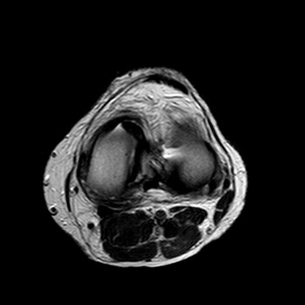 File:Bucket handle tear - medial meniscus (Radiopaedia 29250-29664 Axial T2 7).jpg