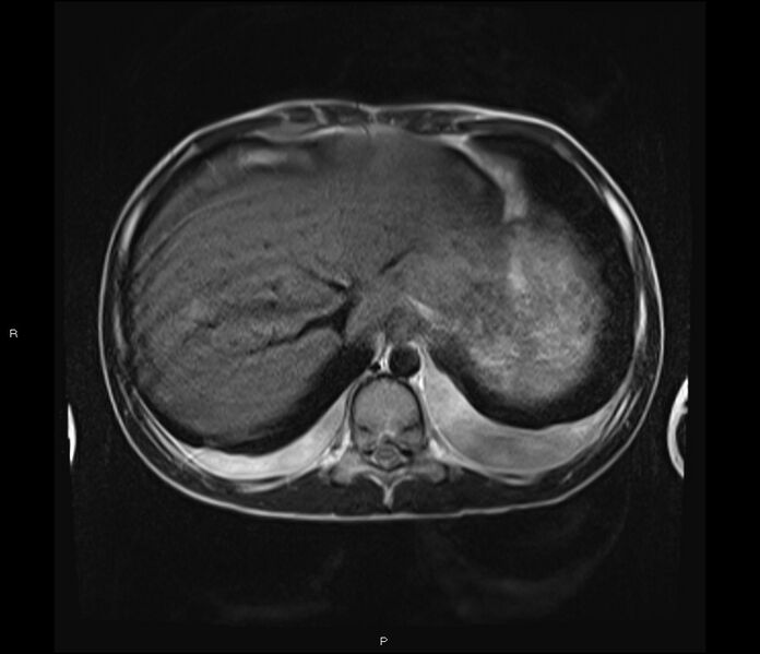 File:Burkitt lymphoma (bowel) (Radiopaedia 68839-78557 Axial T2 9).jpg