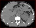 Burned-out testicular choriocarcinoma (Radiopaedia 32822-34040 Axial non-contrast 4).jpg