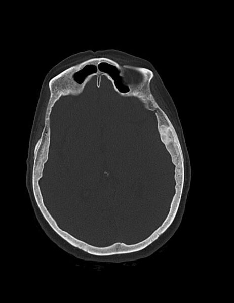 File:Burnt-out meningioma (Radiopaedia 51557-57337 Axial bone window 24).jpg