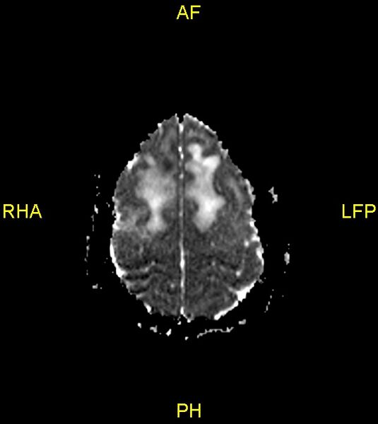 File:Butterfly glioma (Radiopaedia 76707-88526 Axial ADC 24).jpg