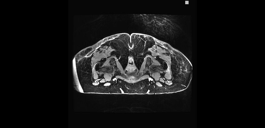 Buttock filler complications (Radiopaedia 63497-72115 Axial T1 C+ 39).jpg