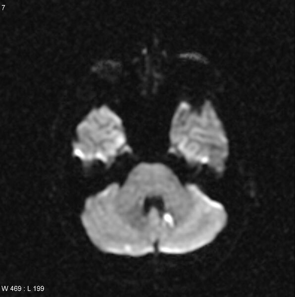 File:CMV ventriculitis and encephalitis (Radiopaedia 5416-7166 Axial DWI 1).jpg
