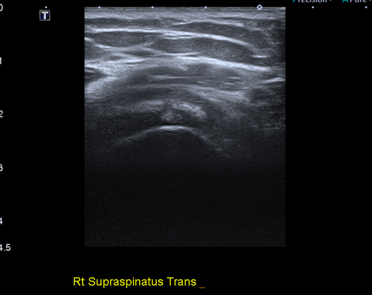 File:Calcific tendinitis (ruptured) (Radiopaedia 56393-63053 A 15).png