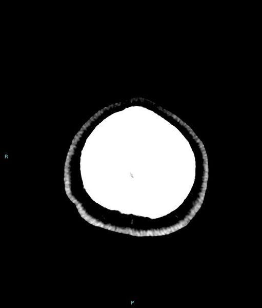 File:Calcified cerebral emboli from left ventricular thrombus (Radiopaedia 84420-99758 Axial non-contrast 5).jpg