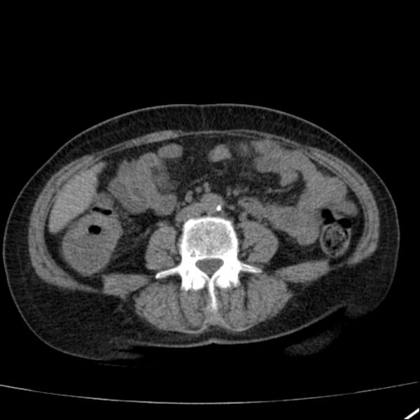 File:Calcified hepatic hydatid cyst (Radiopaedia 26872-27046 Axial non-contrast 50).jpg