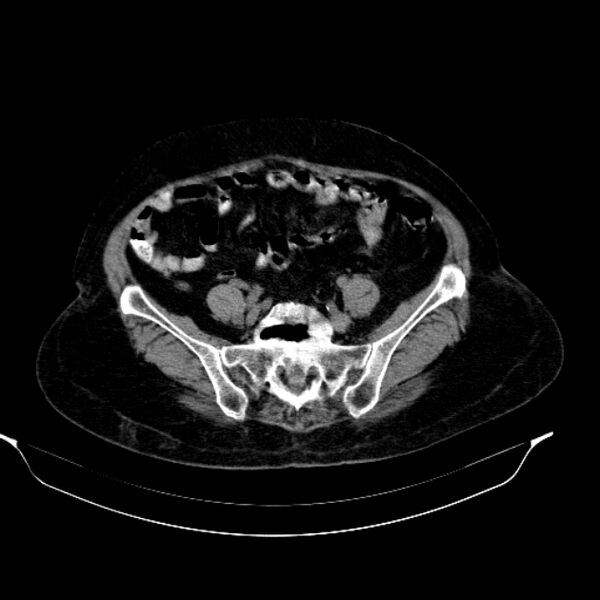 File:Calcified hydatid cyst (Radiopaedia 62000-70085 Axial non-contrast 80).jpg