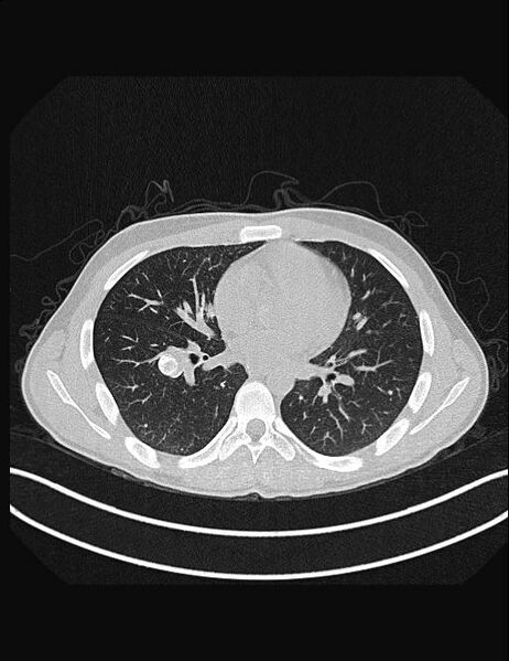 File:Calcifying pulmonary metastases (Radiopaedia 33359-34396 Axial lung window 35).jpg