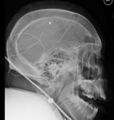 Calvarial thickening from chronic ventricular shunting (Radiopaedia 31883).jpg