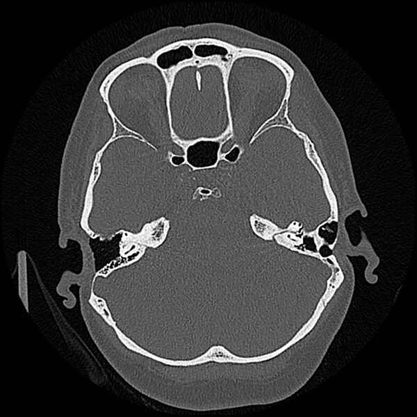 File:Canal up mastoidectomy (Radiopaedia 78108-90638 Axial bone window 96).jpg