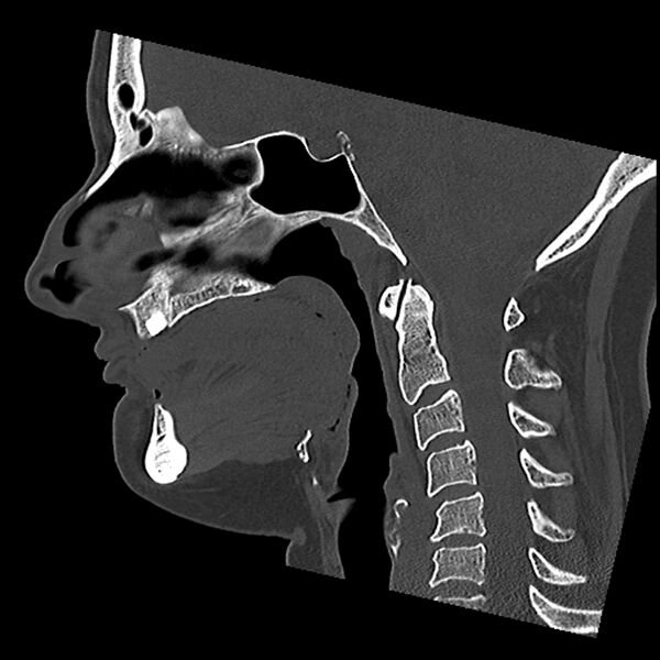 File:Canal up mastoidectomy (Radiopaedia 78108-90638 Sagittal bone window 34).jpg