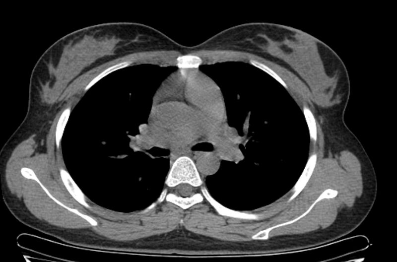 File:Cannonball metastases - uterine choriocarcinoma (Radiopaedia 70137-80173 Axial non-contrast 44).jpg