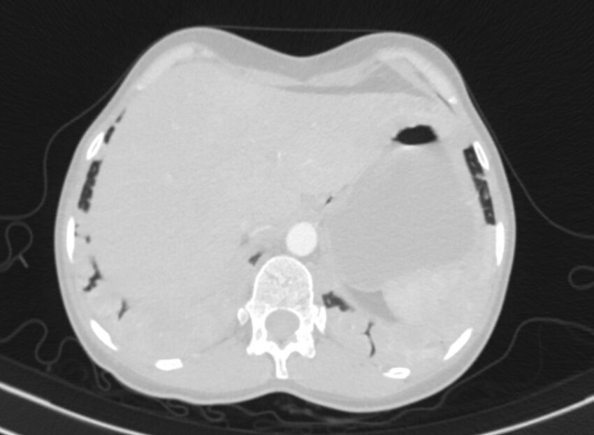 Cannonball metastases from breast cancer (Radiopaedia 91024-108569 Axial lung window 95).jpg