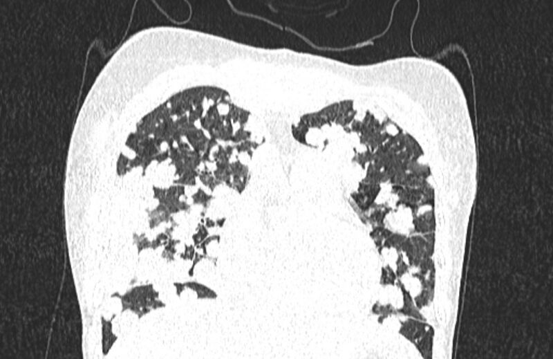 File:Cannonball metastases from breast cancer (Radiopaedia 91024-108569 Coronal lung window 42).jpg