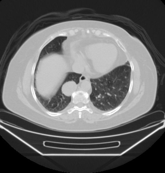 File:Carcinoid tumor - lung (Radiopaedia 44814-48646 Axial lung window 1).PNG
