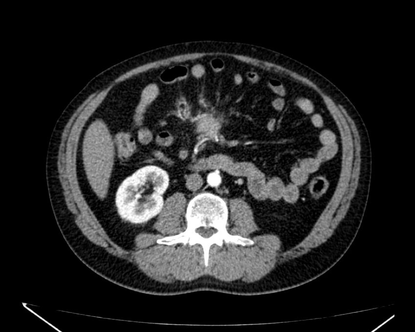 Carcinoid tumor with hepatic metastases (Radiopaedia 22651-22670 B 45).jpg