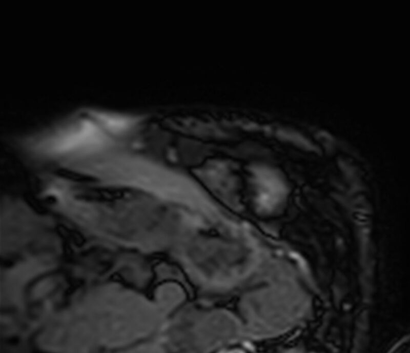 Cardiac amyloidosis (Radiopaedia 39736-42124 F 15).jpg