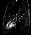 Cardiac hemangioma (Radiopaedia 16971-64065 Multiplanar 10).JPG