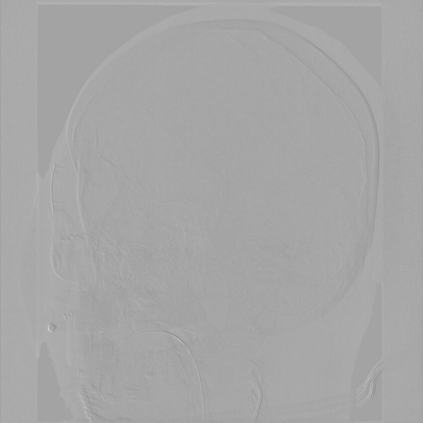 Caroticocavernous fistula - direct (Radiopaedia 61660-69666 Oblique Left ICA 4).jpg