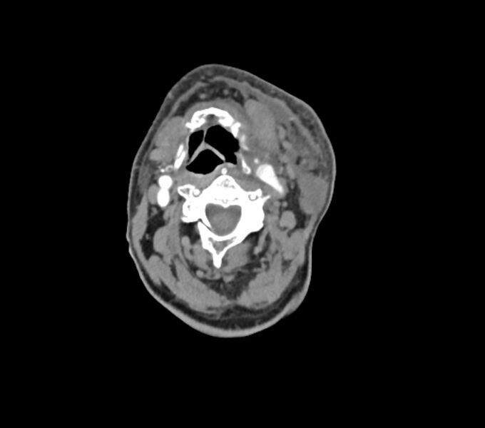 File:Carotid artery pseudoaneurysm (Radiopaedia 84030-99259 C 36).jpg