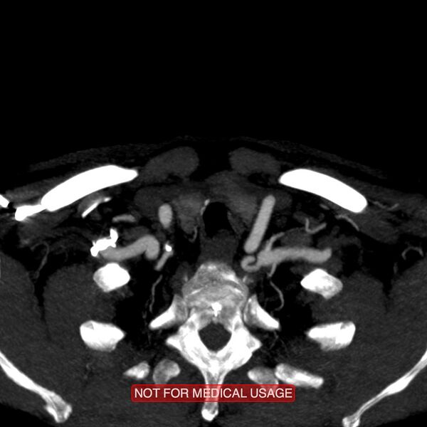 File:Carotid artery stenosis (Radiopaedia 28786-29086 C 25).jpg