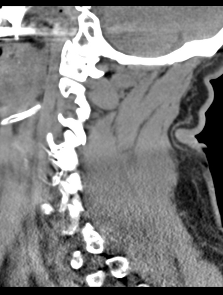 File:Cavernoma of cervical cord (Radiopaedia 50838-56346 B 26).png