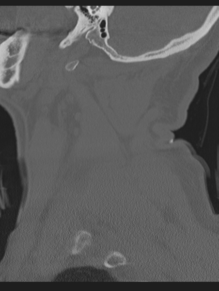 File:Cavernoma of cervical cord (Radiopaedia 50838-56346 Sagittal bone window 12).png