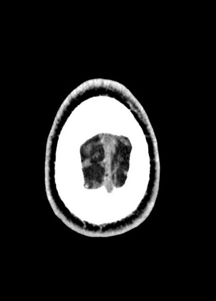 File:Cavum septum pellucidum and cavum vergae (Radiopaedia 77797-90060 Axial Brain Window 100).jpg