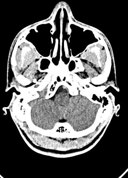 File:Cavum septum pellucidum and cavum vergae (Radiopaedia 77797-90060 Axial Brain Window 17).jpg