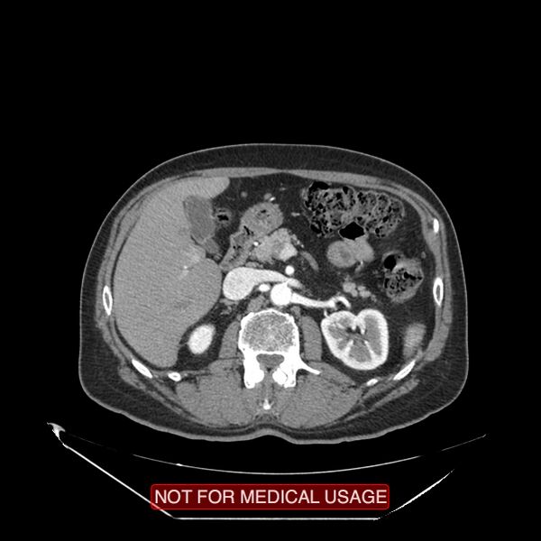 File:Celiac trunk variant anatomy - gastrohepatic trunk and splenic artery (Radiopaedia 38815-40995 A 39).jpg