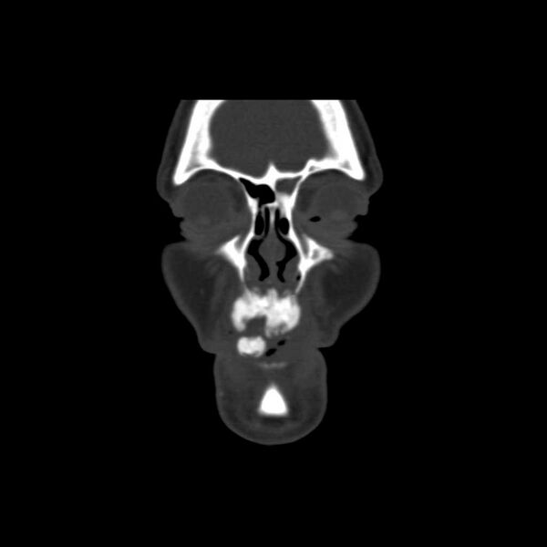 File:Cemento-ossifying fibroma (Radiopaedia 21243-21149 Coronal bone window 4).jpg
