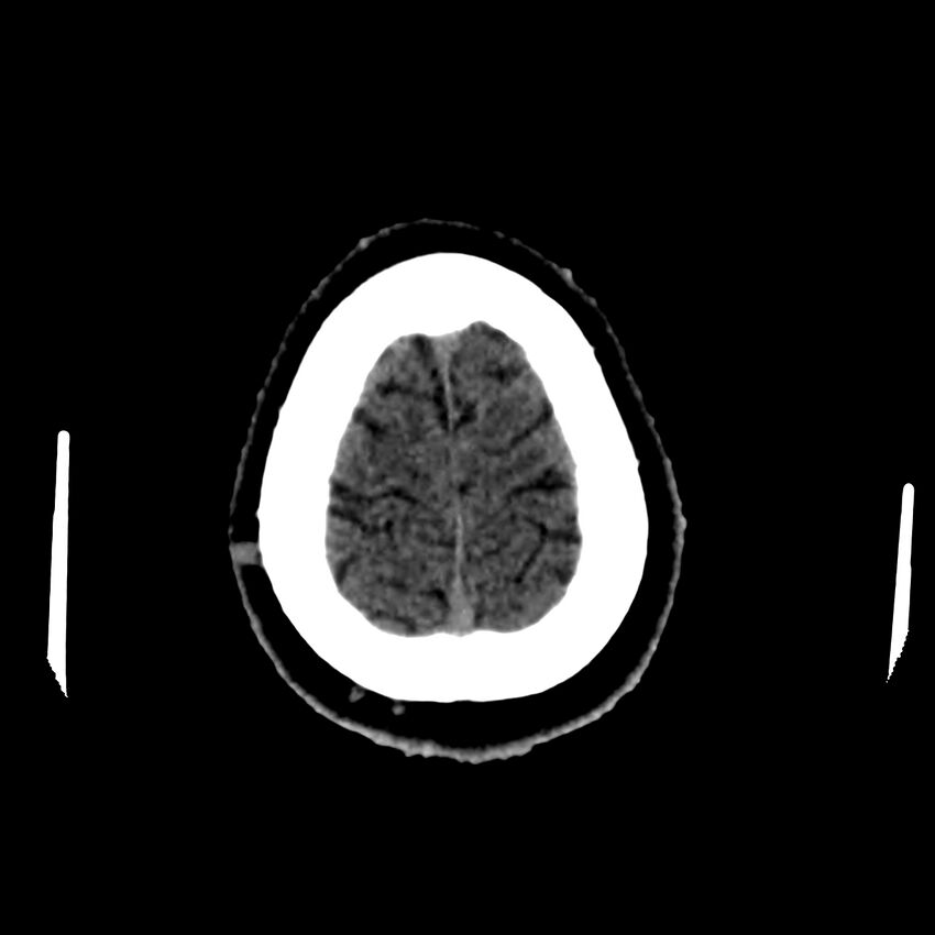 Central nervous system Langerhans cell histiocytosis (Radiopaedia 65728-74878 Axial non-contrast 47).jpg