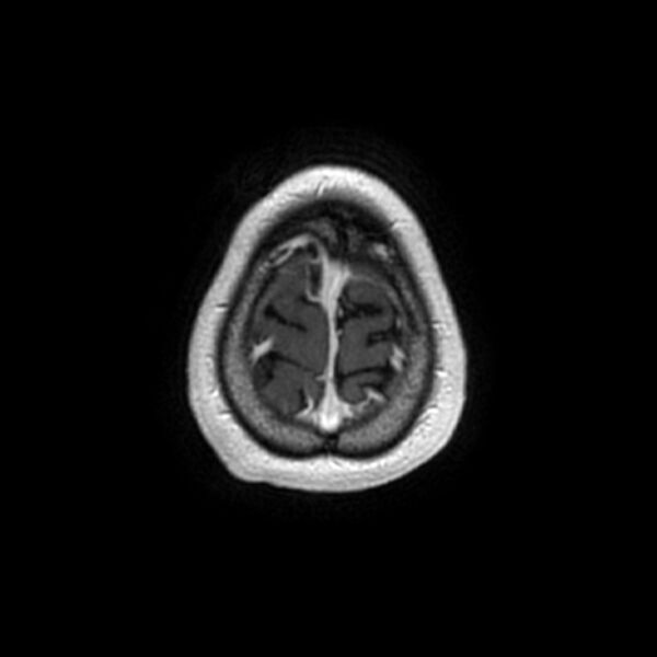 File:Central neurocytoma (Radiopaedia 67618-77021 Axial T1 C+ 28).jpg