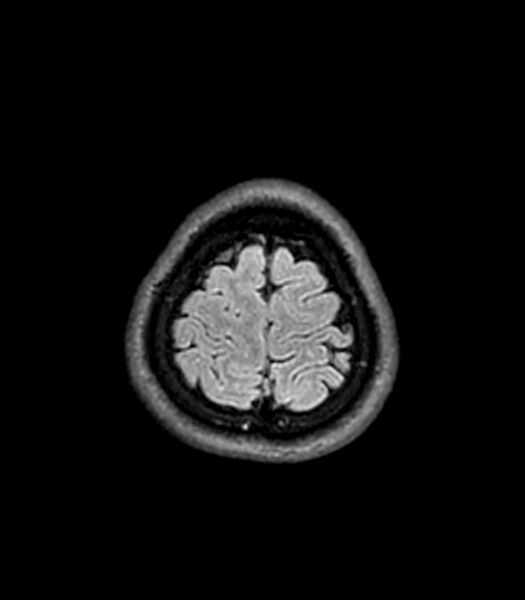 File:Central neurocytoma (Radiopaedia 79320-92380 Axial FLAIR 50).jpg