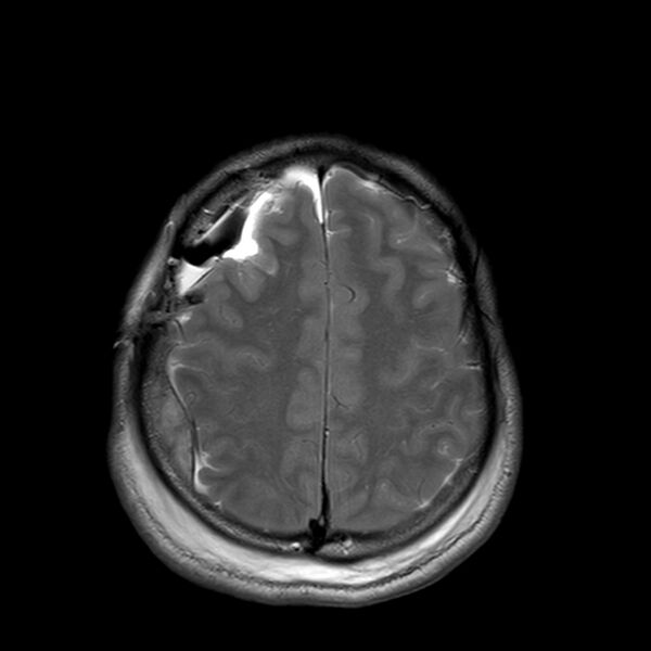 File:Central neurocytoma (Radiopaedia 79320-92381 Axial T2 21).jpg