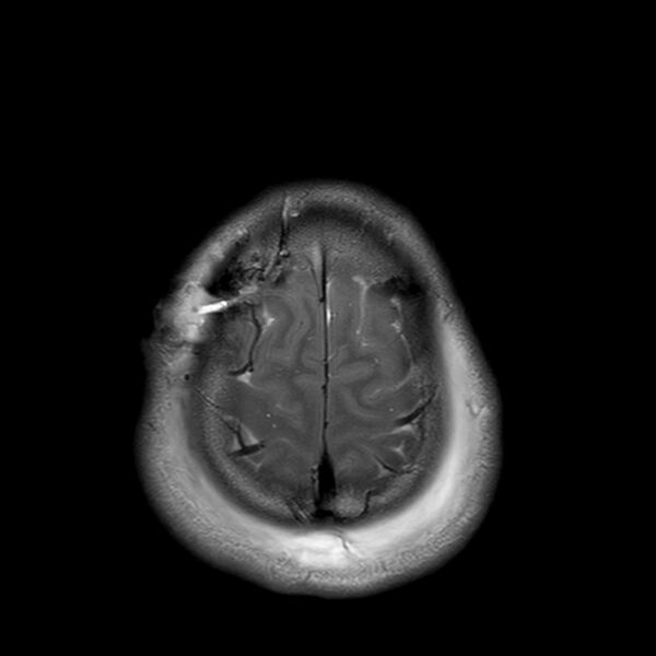 File:Central neurocytoma (Radiopaedia 79320-92381 Axial T2 24).jpg