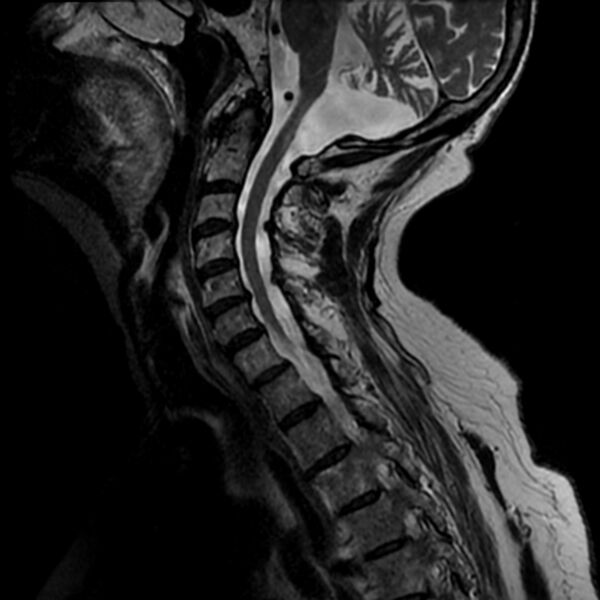 File:Cerebellar ataxia with neuropathy and vestibular areflexia syndrome (CANVAS) (Radiopaedia 74283-85159 Sagittal T2 6).jpg