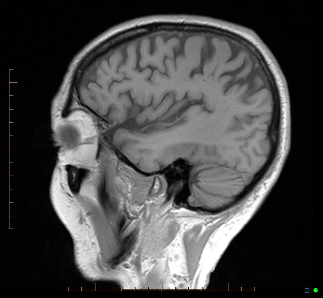 File:Cerebellar gangliocytoma (Radiopaedia 65377-74422 Sagittal T1 9).jpg