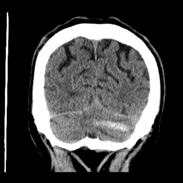 File:Cerebellar hemorrhage (Radiopaedia 27193-27359 Coronal non-contrast 48).jpg