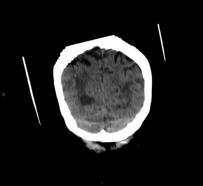 File:Cerebellar hemorrhage (Radiopaedia 58792-66026 Coronal non-contrast 15).jpg